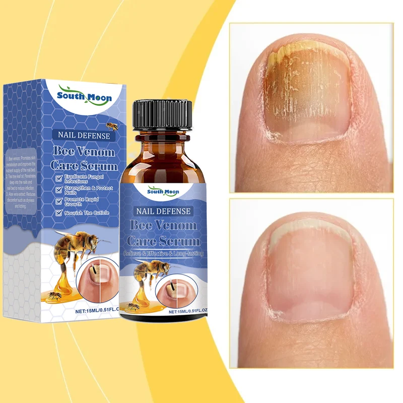 Bee Venom Nail Fungus Solution Hand Foot Care Toenail Thickening Yellowing Essence Ingrown Nail Gray Bright Nail Repair Product