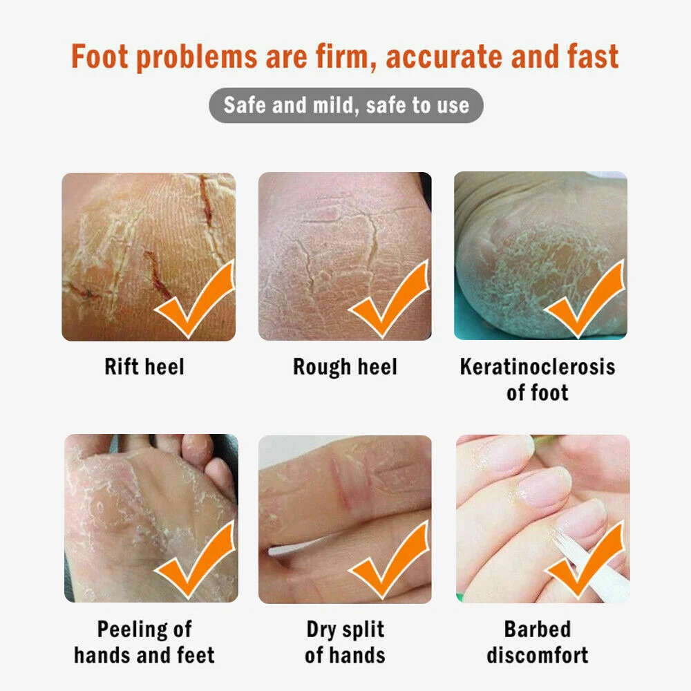 20g, Foot Crack Repair Balm Cream Natural Banana Peel Extract Skin Crack Repair Balm Moisturizing Cracked Heeling Skin Repair