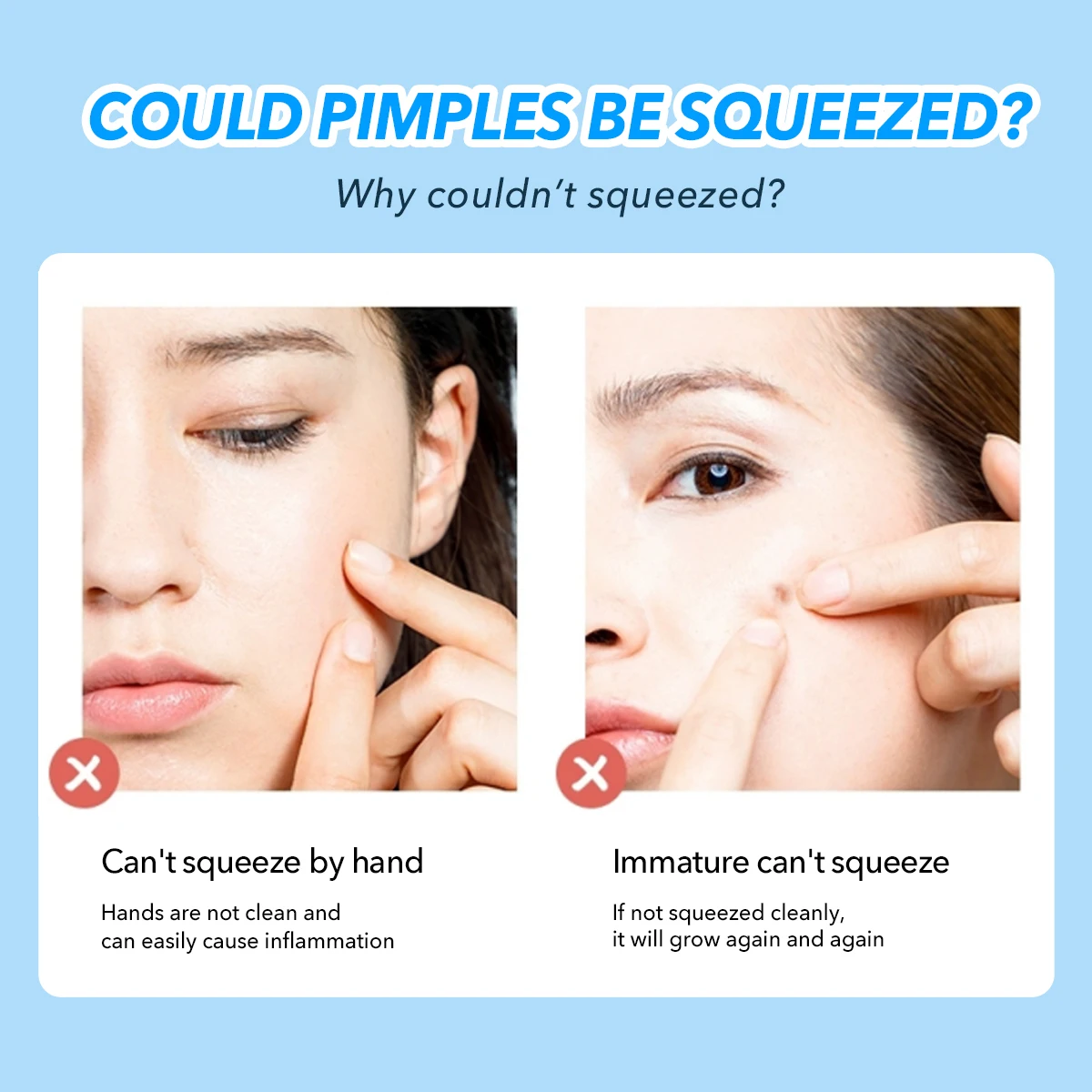 IMAGIC 4 unid/set de agujas de eliminación de espinillas y acné de acero inoxidable, limpiador de poros y manchas negras, limpiador de belleza, herramienta de cuidado de la piel facial