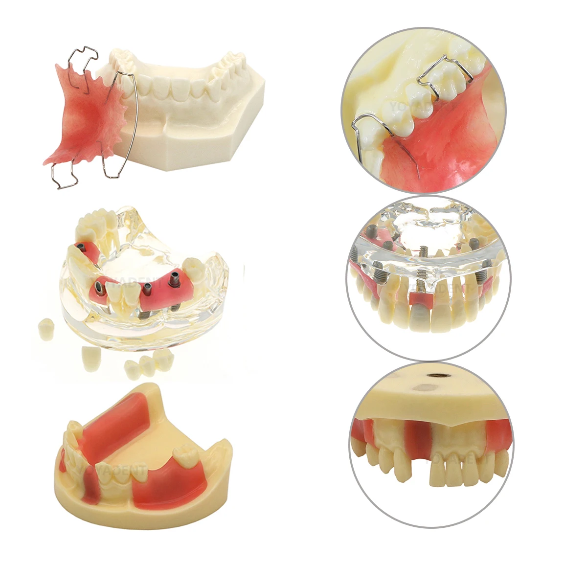 Dental Teeth Implant Model Implant Overdenture 2/4 Implant Upper Lower Jaw Mandibular For Dentist Student Study Learning