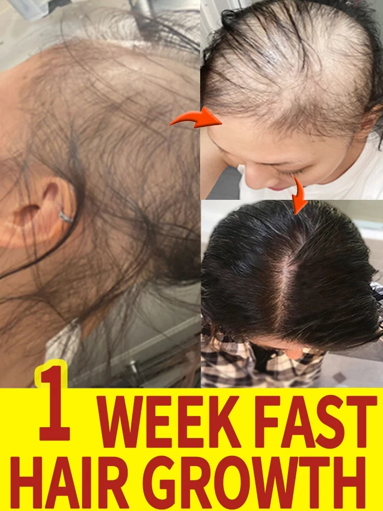 Sólo se necesitan 7 días para reparar la calvicie. El aceite esencial para el crecimiento del cabello puede reparar eficazmente