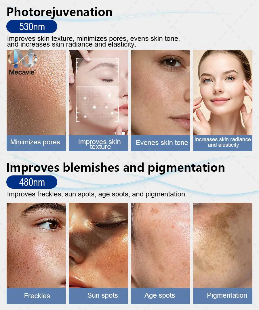 4 In 1 Soprano Titanium Ice Laser Hair Removal Device Alexandrite 808nm Diode Laser System Painless Permanent Body Hair Removal