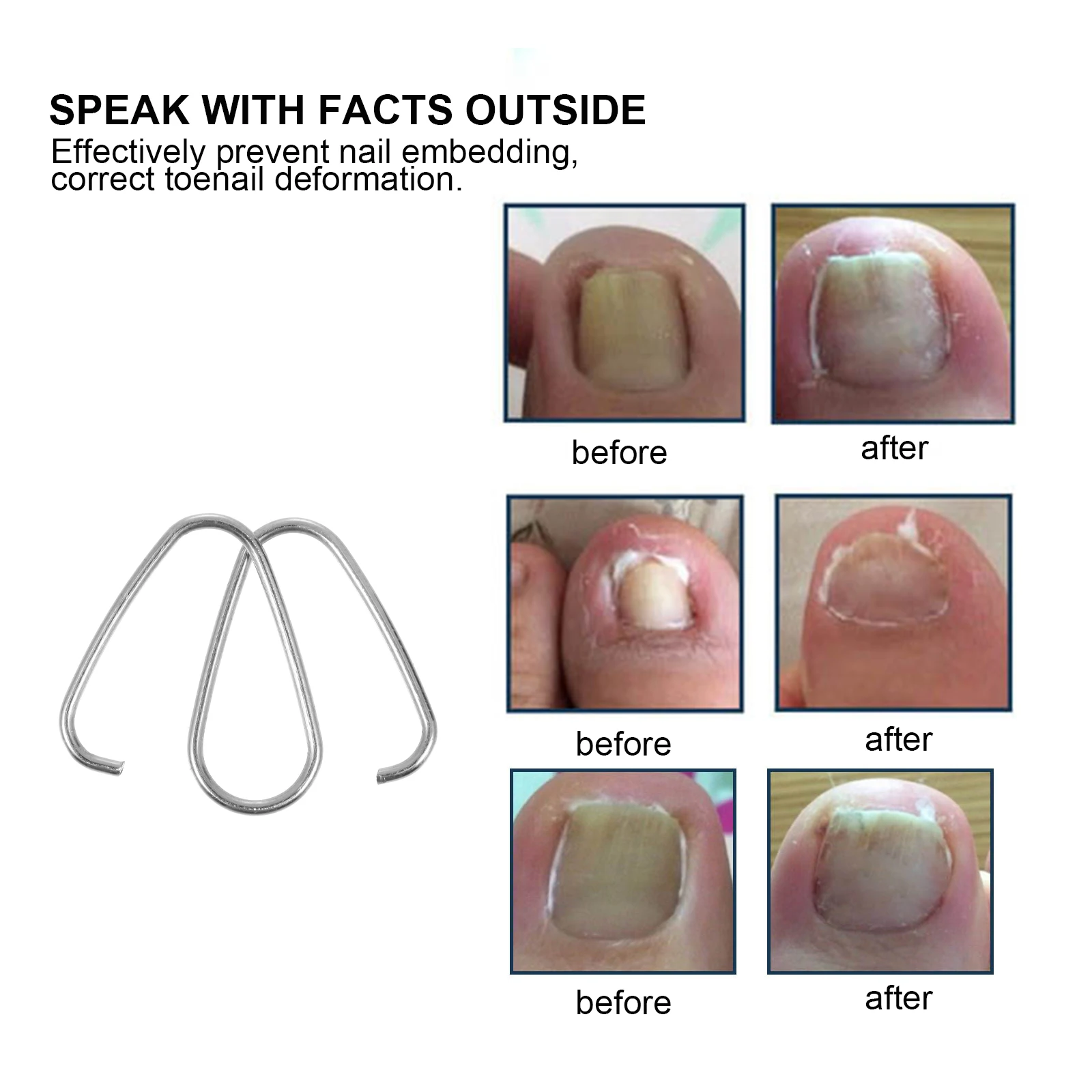 

12pcs Toenail Correction Hooks Stainless Steel Durable Nail Care Toe Paronychia Tool Pedicure Wire Straighteners