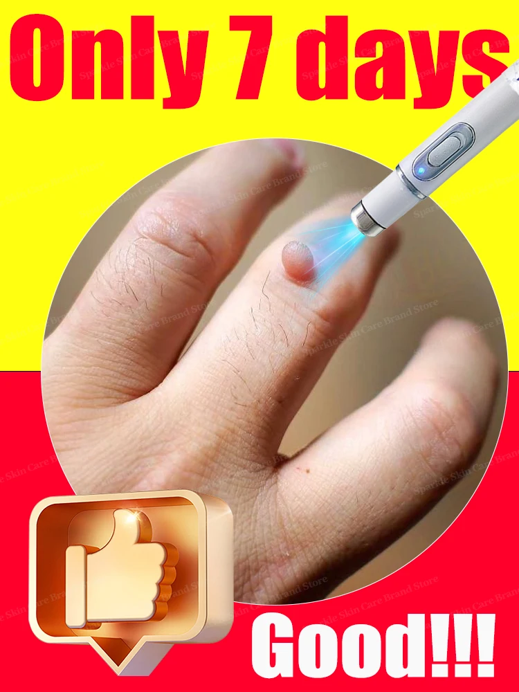 

Warts Blue Light Tool, Easy To Clean Skin Care Tool