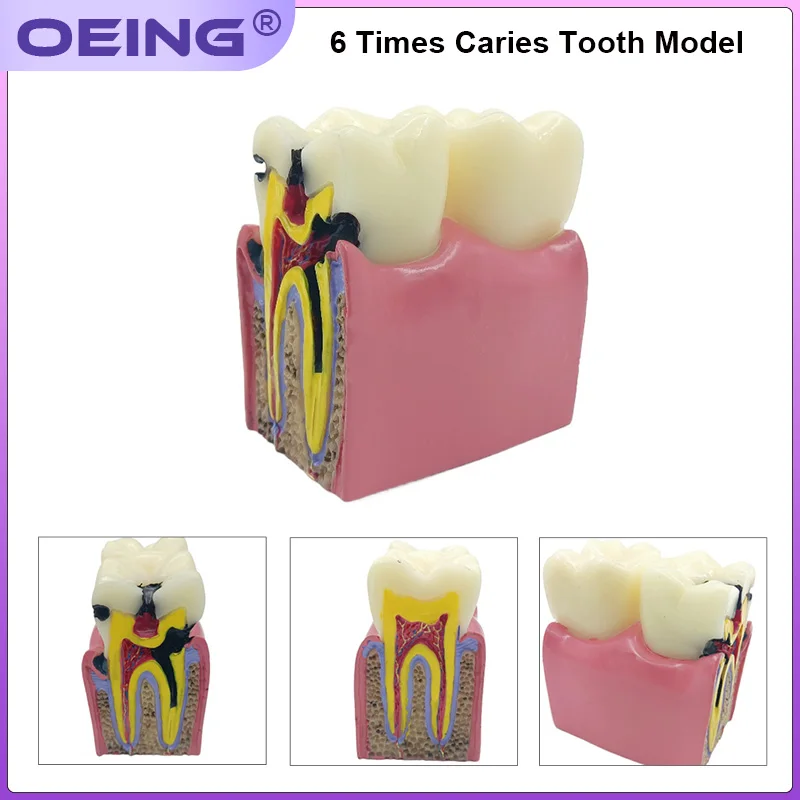 OEING 1Pc Dental Teaching Teeth Model 6 Times Dental Caries Model For Dental Demonstration Model Lab Oral Research Tool