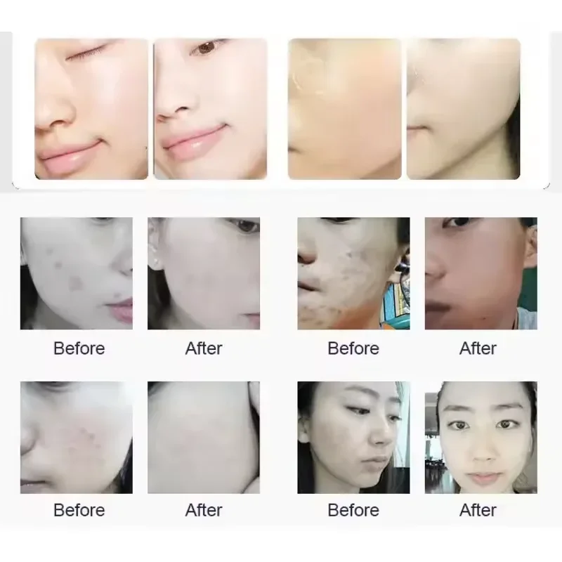 360 °   Nieuwste 6in1 Water Dermabrasie Apparaat Zichtbare Mee-eter Acne Verwijdering Zuurstof Jet Peel Diepe Gezichtsreiniging Schoonheid Machine
