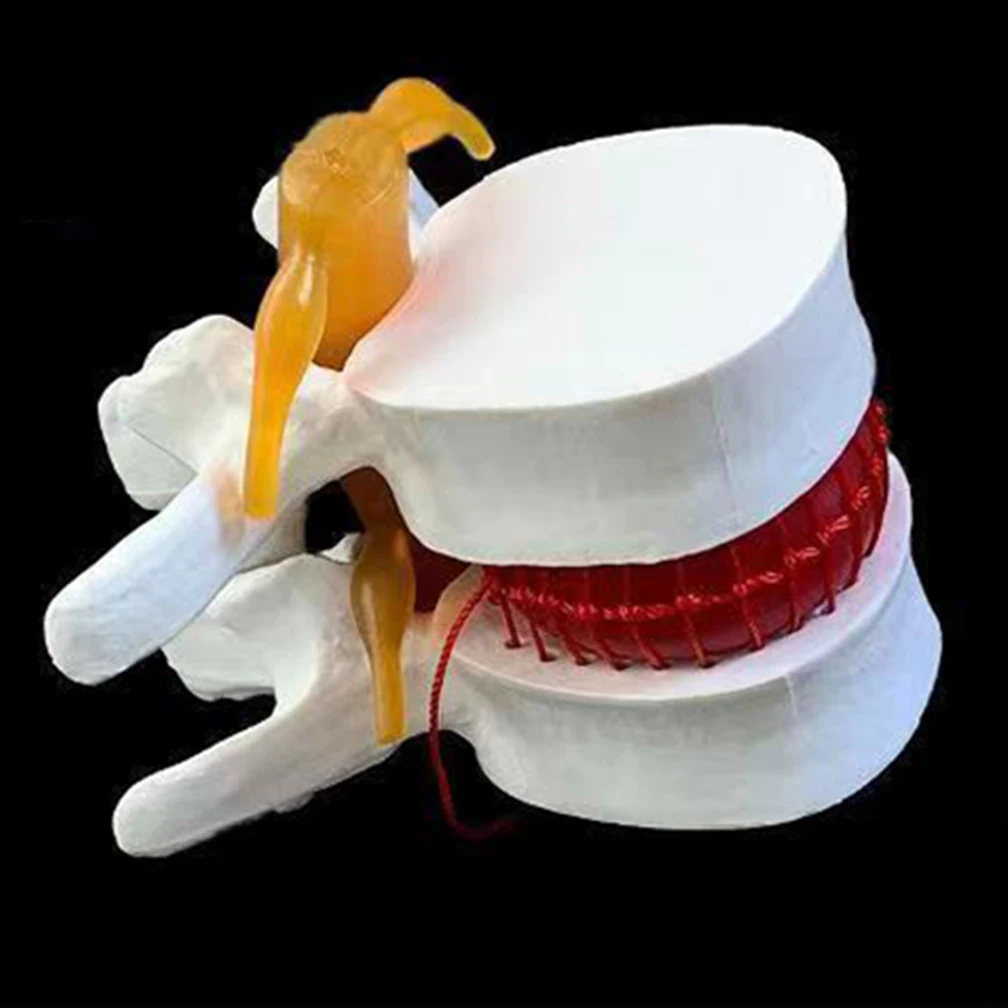 Human Anatomy Skeleton Spine Lumbar Disc Herniation Teaching Model Traumatic School Education Supplies White Yellow Wholesale