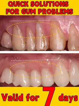 Repara gengivas danificadas, resolve periodontite e fortalece gengivas