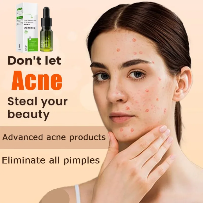 

Acne Removing&Anti acne Cream Treatment of Acne Marked Skin Care Whitening&Acne Removing face cream Smooth&Whitening face cream