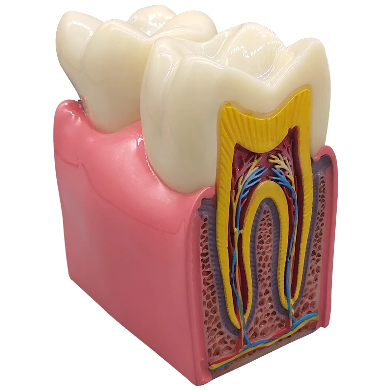 Modelo de implante Dental con aumento de 6/8x, Caries, modelo de dientes de contraste, modelos de implante Dental de corona para comunicación