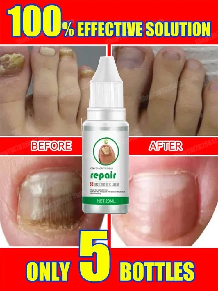 Tratamento de fungos nas unhas, essência para cuidados com os pés, clareamento dos pés, remoção de fungos nas unhas dos pés, gel anti-infecção, paroníquia, onicomicose