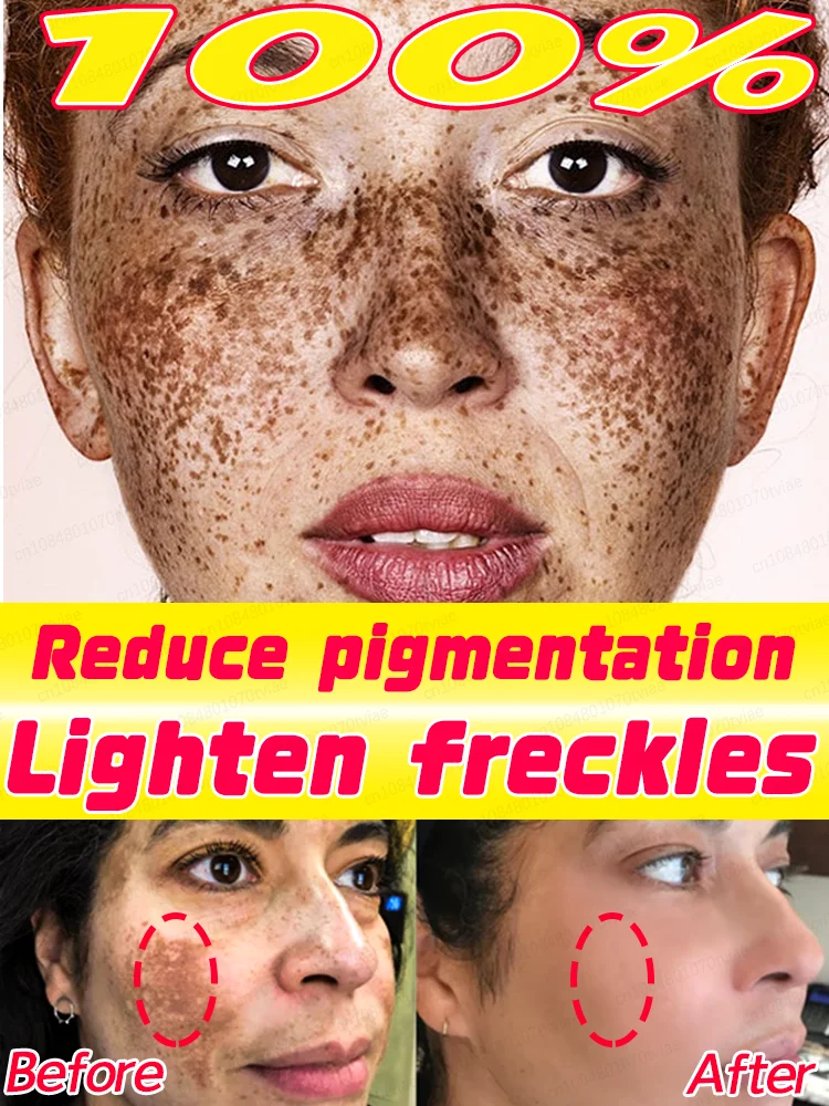 

100% effective against freckles and pigmentation problems Reduces pigmentation Lightens freckles