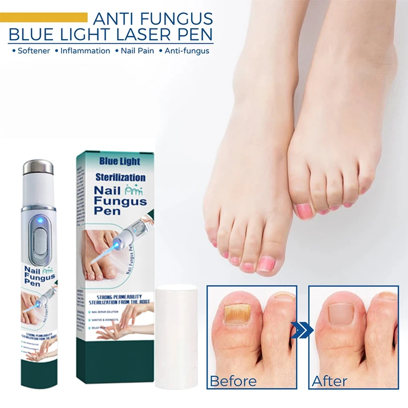 Fungus Care Repair Pen Anti Fungus Blue Light Repair Pen Onychomycosis Painless Removal Foot Repair Products Laser Pointer
