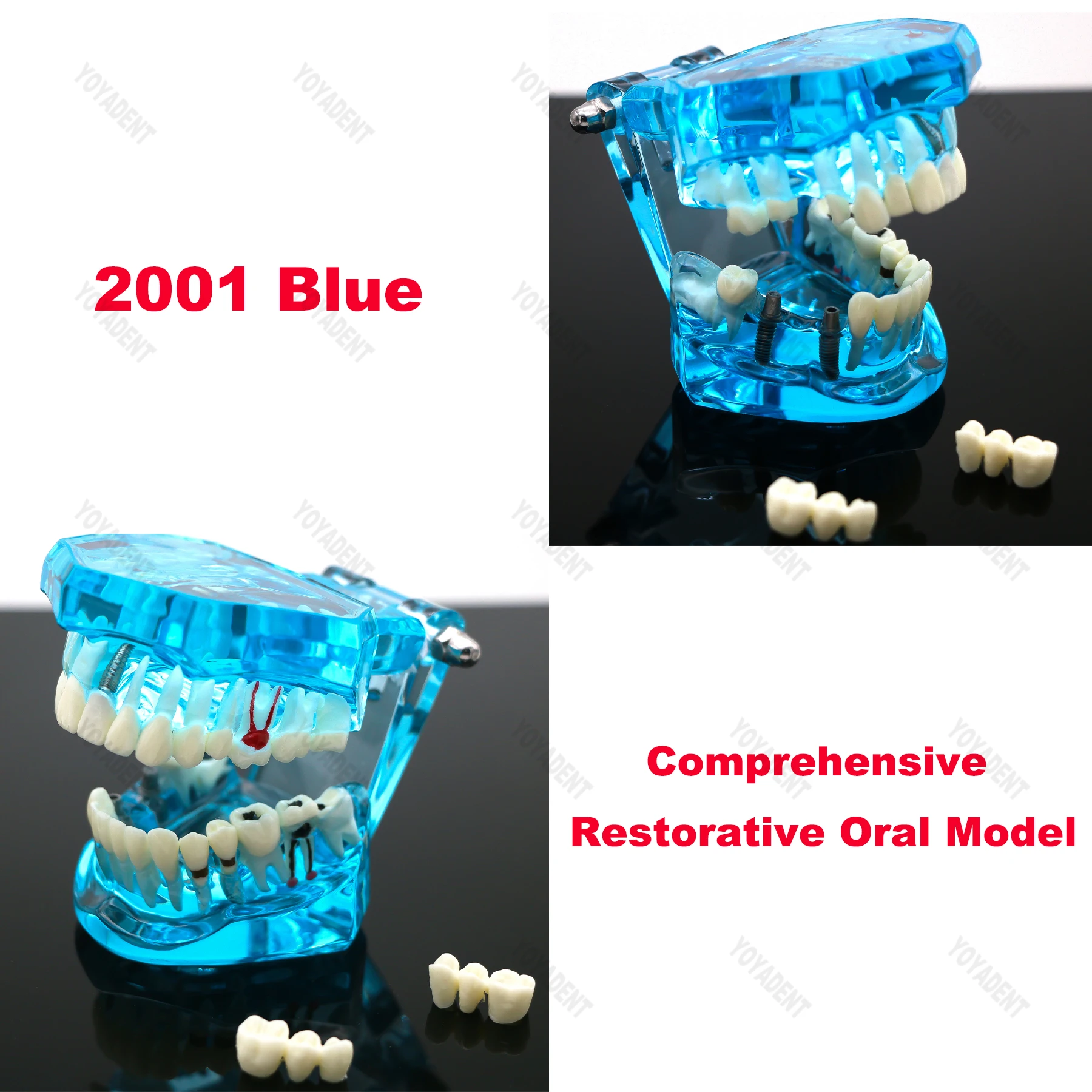 نموذج ترميم زرع الأسنان نموذج لتدريس طبيب الأسنان دراسة طب الأسنان منتجات طب الأسنان المعيار الأزرق 1:1 #2