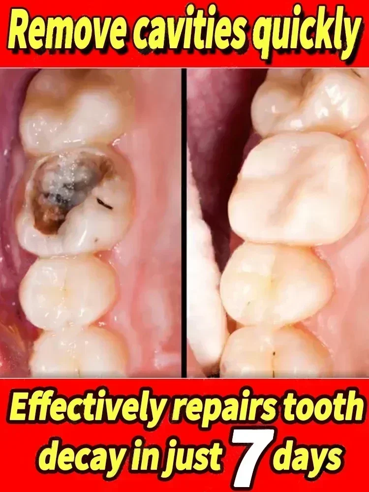 02 Repair of Cavities Caries Removal of Plaque Stains Decay Repair Teeth Treating Dental Calculus Toothpaste of Teeth Whitening