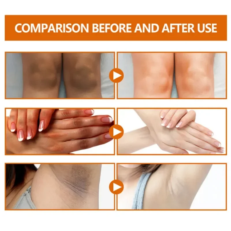 Dark knuckles whitening serum Elbows Armpit Beaching SerumWoman Private Part Skin Removal Dark Knuckles Strong Whitening Serum