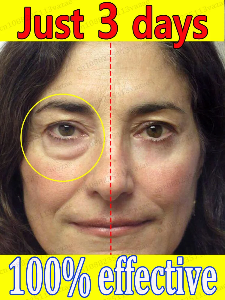 

Eʟɪᴍɪɴᴀᴛᴇ ᴇʏᴇ ʙᴀɢs, ᴅᴀʀᴋ ᴄɪʀᴄʟᴇs, ᴀɴᴅ ᴡʀɪɴᴋʟᴇs