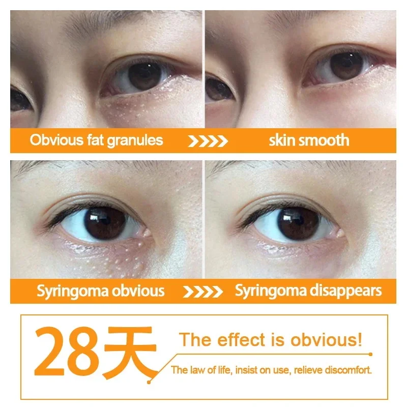 Fat Granules Remover Eye Cream Anti-Puffiness Firm Cream Anti Inflammatory Fade Fine Line Repair Skin Barrier Korean Skin Care