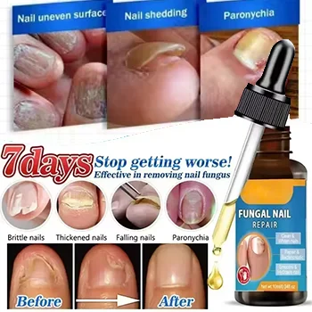 Fungal Nail Treatment Oil Foot Repair Essence Toe Nail Fungus Removal Gel Anti Infection Cream Fungal Nail Removal Paronychia