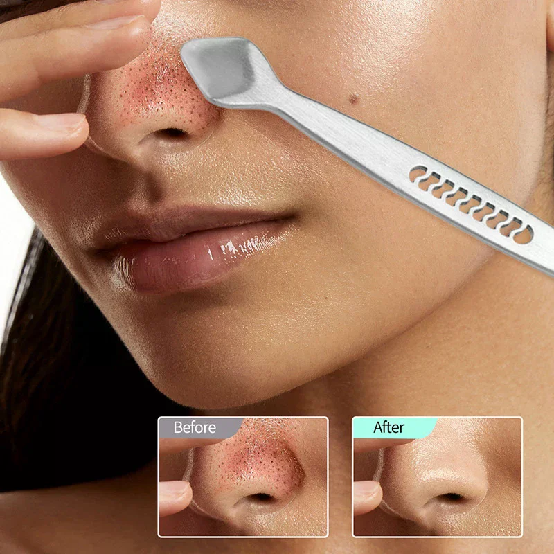 ダブルヘッドにきび除去ツールステンレス鋼にきびにきび皮脂除去顔の傷抽出ツール顔のスキンケア用