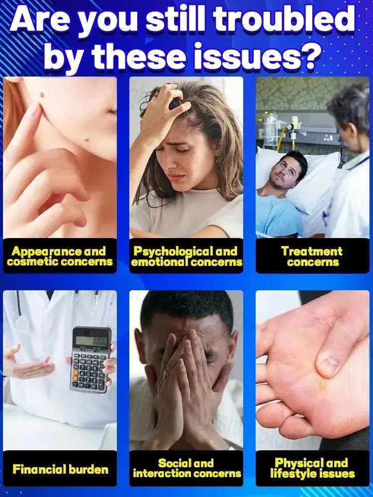 LsWs RWave Off Those Etiquetas de piel sin invitar Removedor de verrugas con luz azul