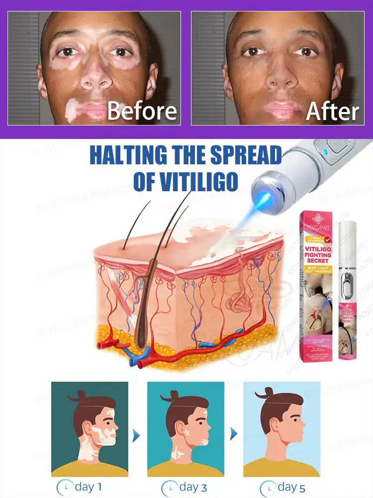 The laser pen is gentle and only acts on the ʷʰⁱᵗᵉ ˢᵖᵒᵗˢ ʷⁱᵗʰᵒᵘᵗ ᵈᵃᵐᵃᵍⁱⁿᵍ ʰᵉᵃˡᵗʰʸ ˢᵏⁱⁿ‧