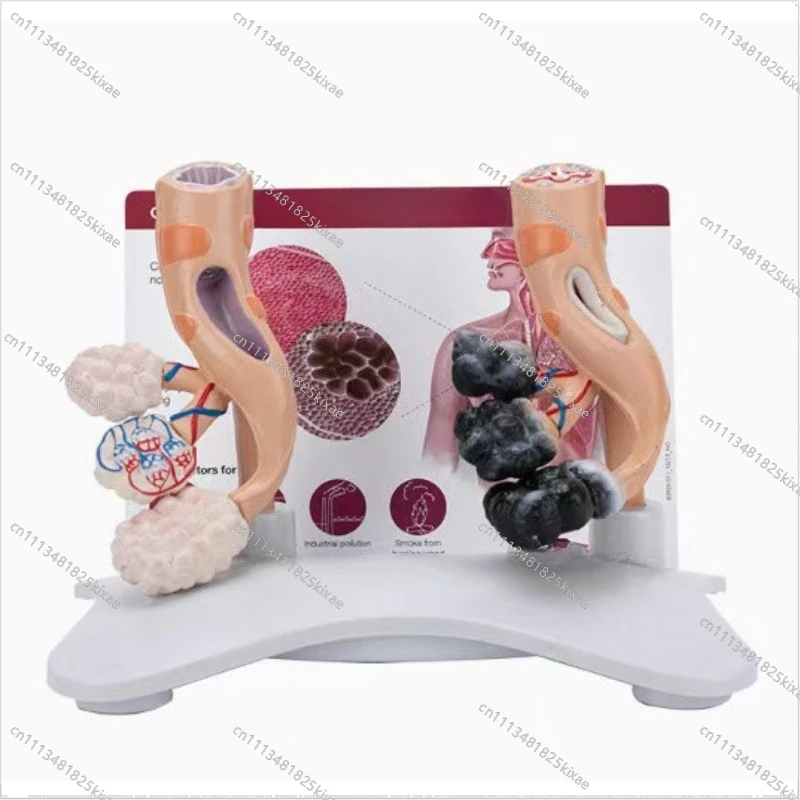 For Smoking Alveoli and Healthy Alveoli Lung Comparison Model Human Lung Respiratory System Teaching Model Mold