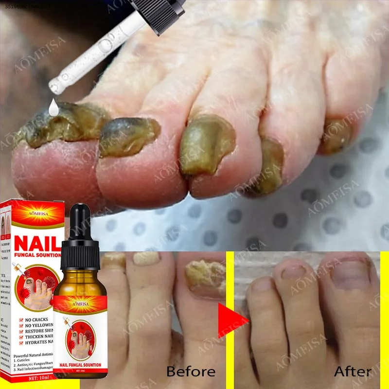 Nail Repair Serum Nail Fungal Removal Onychomycosis Paronychia Treatment Nail Softener Ingrown Toenail Care Essence 7 Days