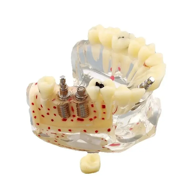 Dental Anatomical Tooth Model M2007 Implant Practice Model Bone Matrix Caries Be In Hot Sale