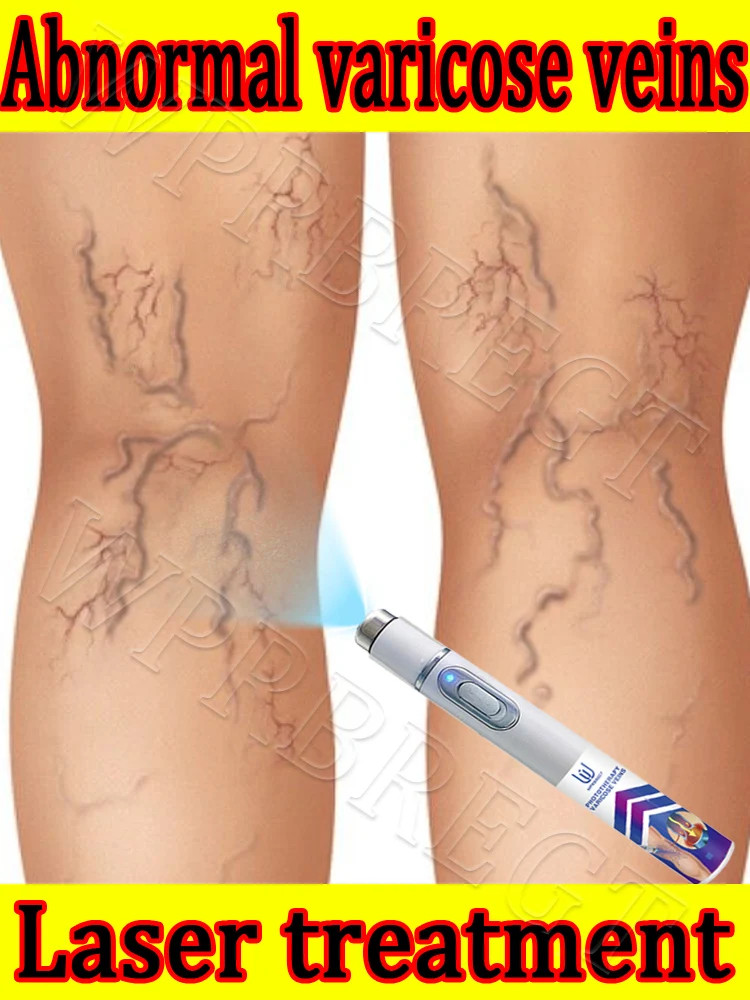

Treating varicose veins in the leg joints