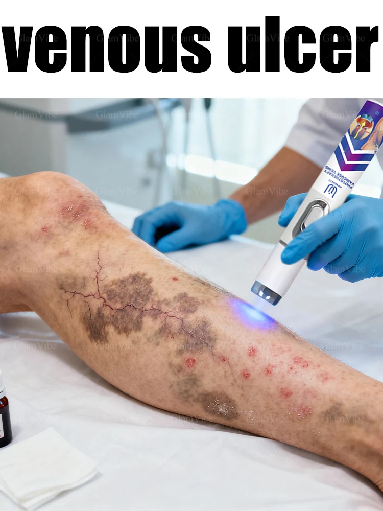 

2025 Hot Sale, Blue Light Pen to Solve Leg Problems, Leg Care Tool, Unisex