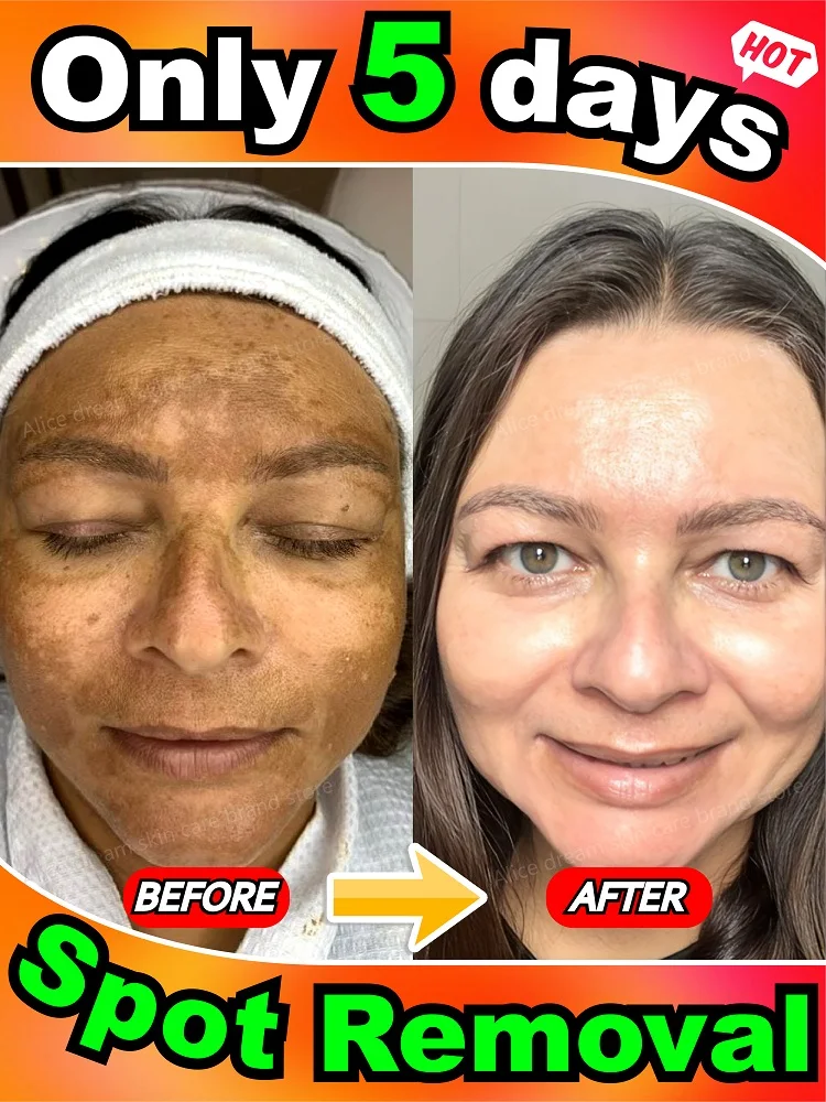 

Facial spots disappear in 5 days