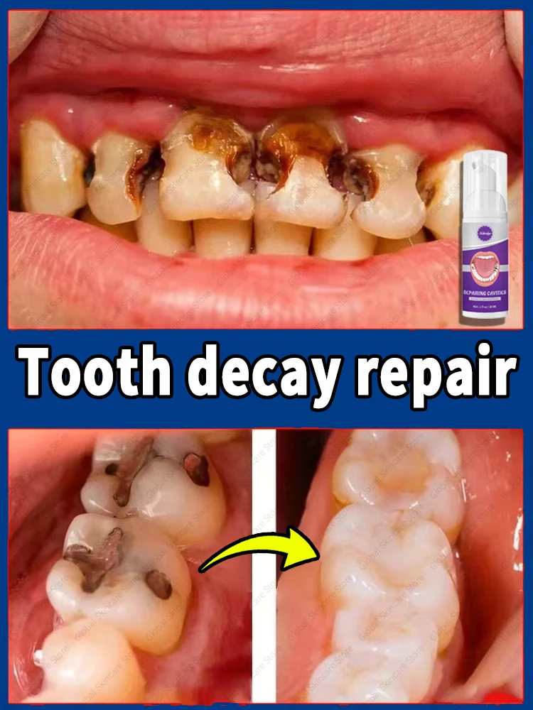 Hot selling Tooth Mousse repair tooth decay removal