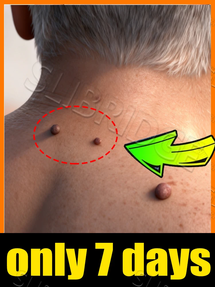 

2025UPGRADE для бородавок, Инструменты для тела,Спроверьте свой проблемы,Унисекс