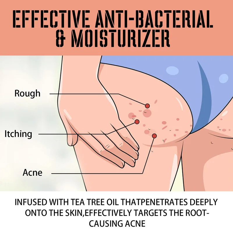 Крем для лечения прыщей и ягодиц, 50 мл