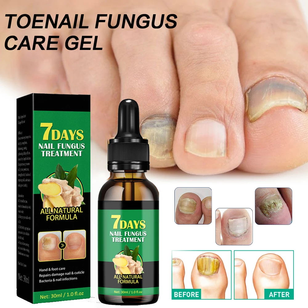 30ml Fungal Nail Treatment Essence Oil Nail Fungus Laser Device Repair Toenail Fingernail Treatment Onychomycosis with Mushrooms