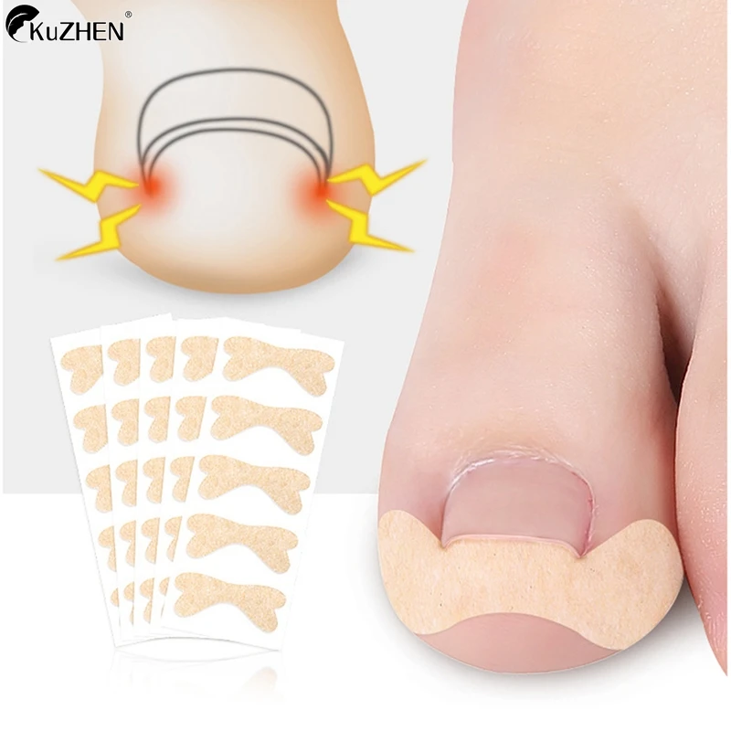 علاج أظافر القدم النامية ، أداة تصحيح أظافر القدم النامية ، ملصق التصحيح المرن ، مشبك استقامة ، دعامة ، أدوات باديكير ، ورقة واحدة