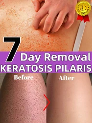 Keratosis Pilaris Cream  Rough Goosebumps Tiny Bumps Red Bumpy Chicken Skin Removal