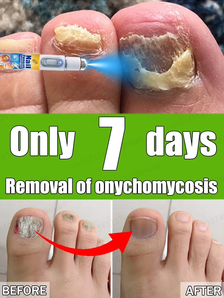 

Say goodbye to onychomycosis and avoid recurrence. Get normal nails again.