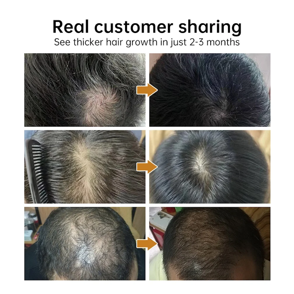 Popular Scalp Health Serum 30ml Anti-Hair Loss Scalp Massager Essence Scalp Care Management Easy Use