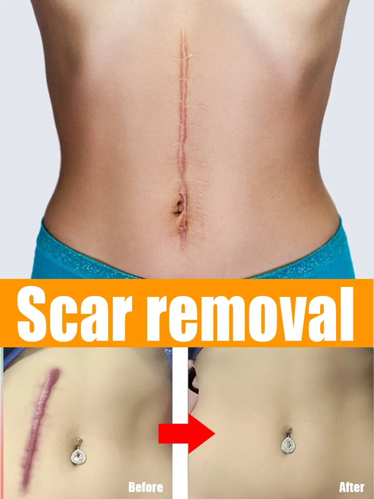 

Scar removal damaged skin scars repair postal operative scar imprint product