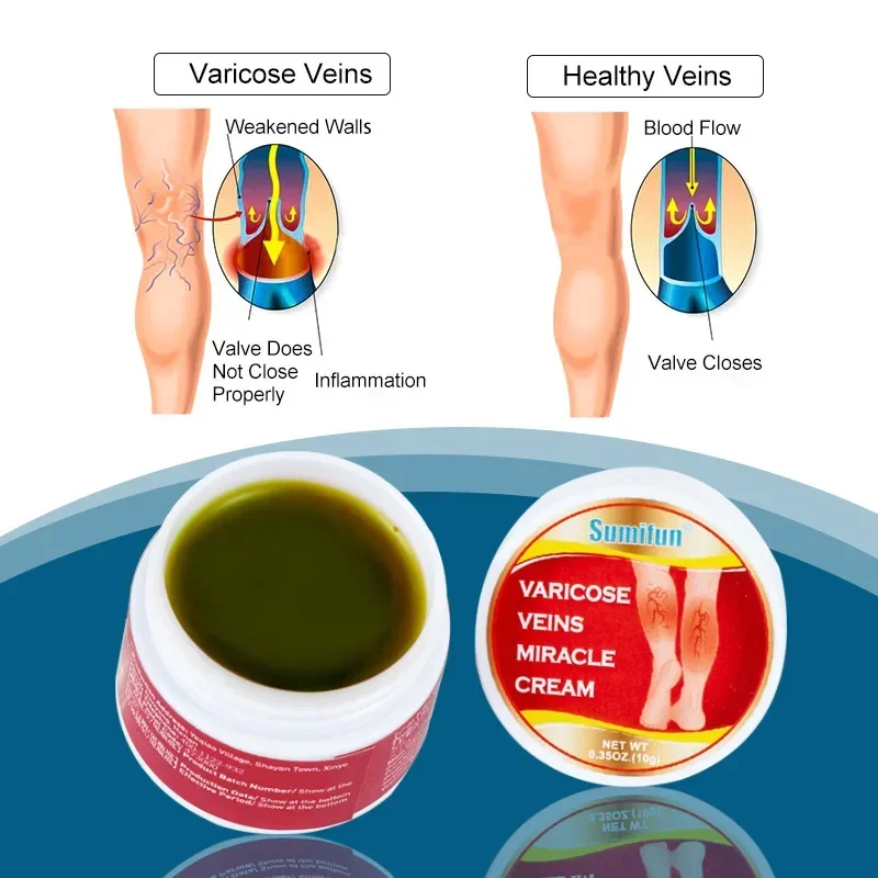 Nowy krem ulga w żylakach Skurcze nóg zapalenie naczyń zapalenie żył kształt pająka wybrzuszenia żył maść przeciwbólowa usunięcie zapalenia naczyń