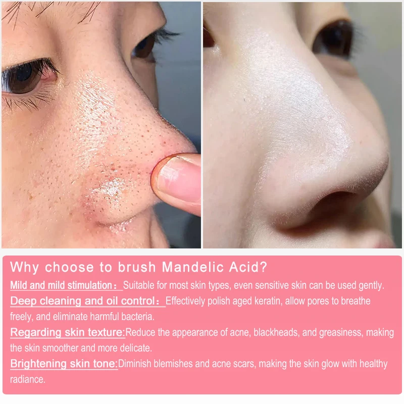 Mandelic Acid 18% almond acid VMA peeling peel face chemical peeling for face Strong