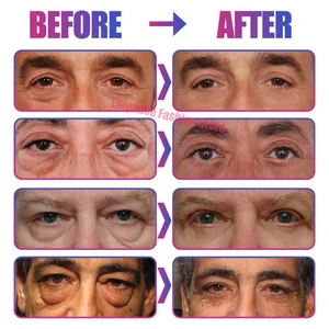 كيس العين الفوري إزالة كريم العين مضاد للدهون الجزيئات الهالات السوداء الهالات السوداء الانتفاخ تتلاشى الخطوط الدقيقة رفع تفتيح العناية بالجمال الكوري للعيون أفضل 8 منتجات كورية للهالات السوداء كريم - No2