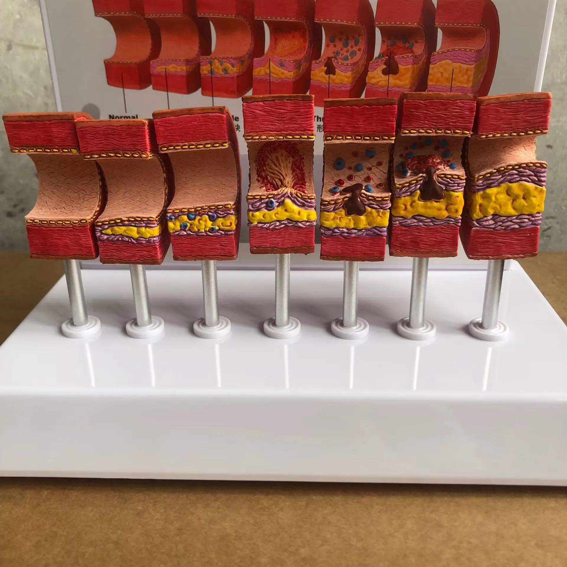 Atherosclerosis Model Vascular Thromboembolism Model Arterial Blood Vessel Human Medical Teaching Model