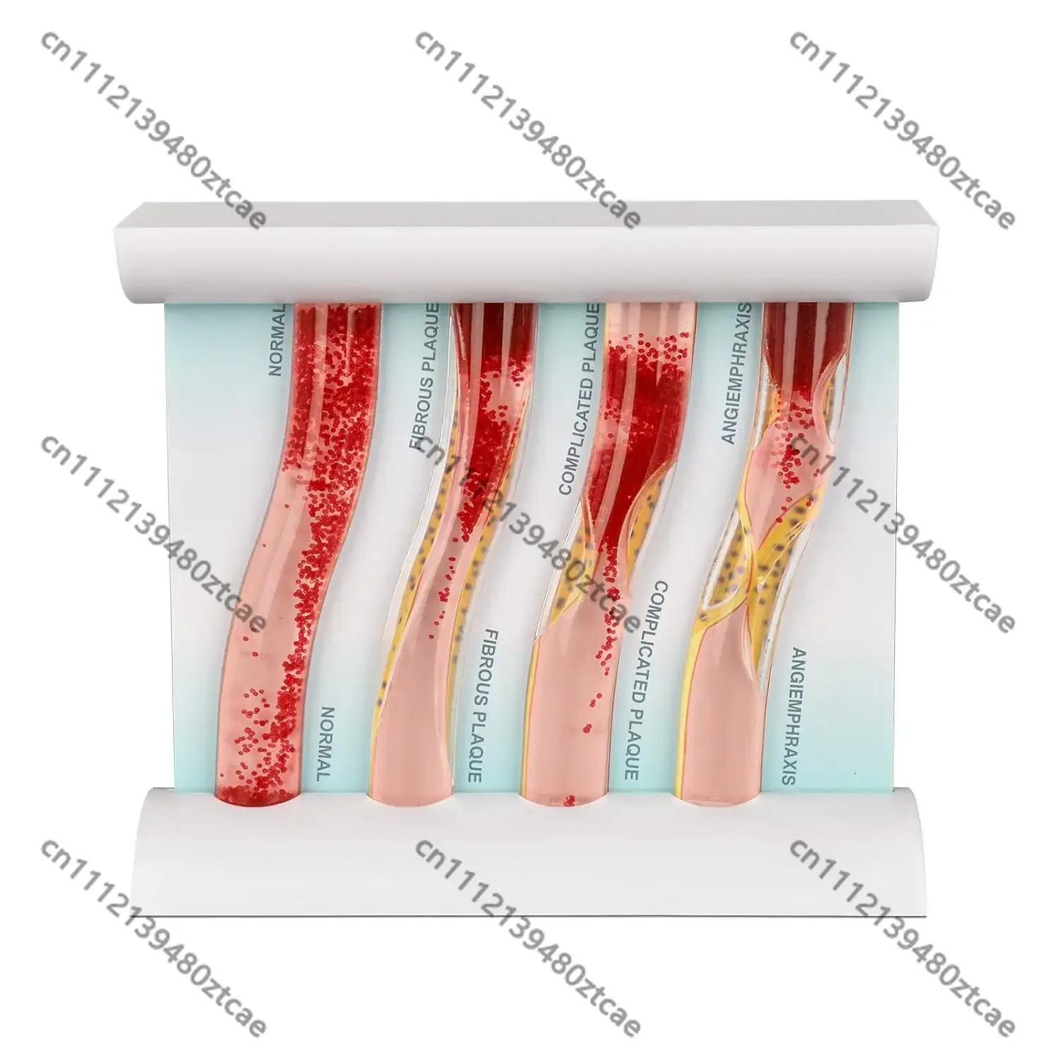 

Cardiovascular Vessel Blockage Model Thrombus Artery Contrast Model Medical Anatomy Teaching Demonstration Learning Aid