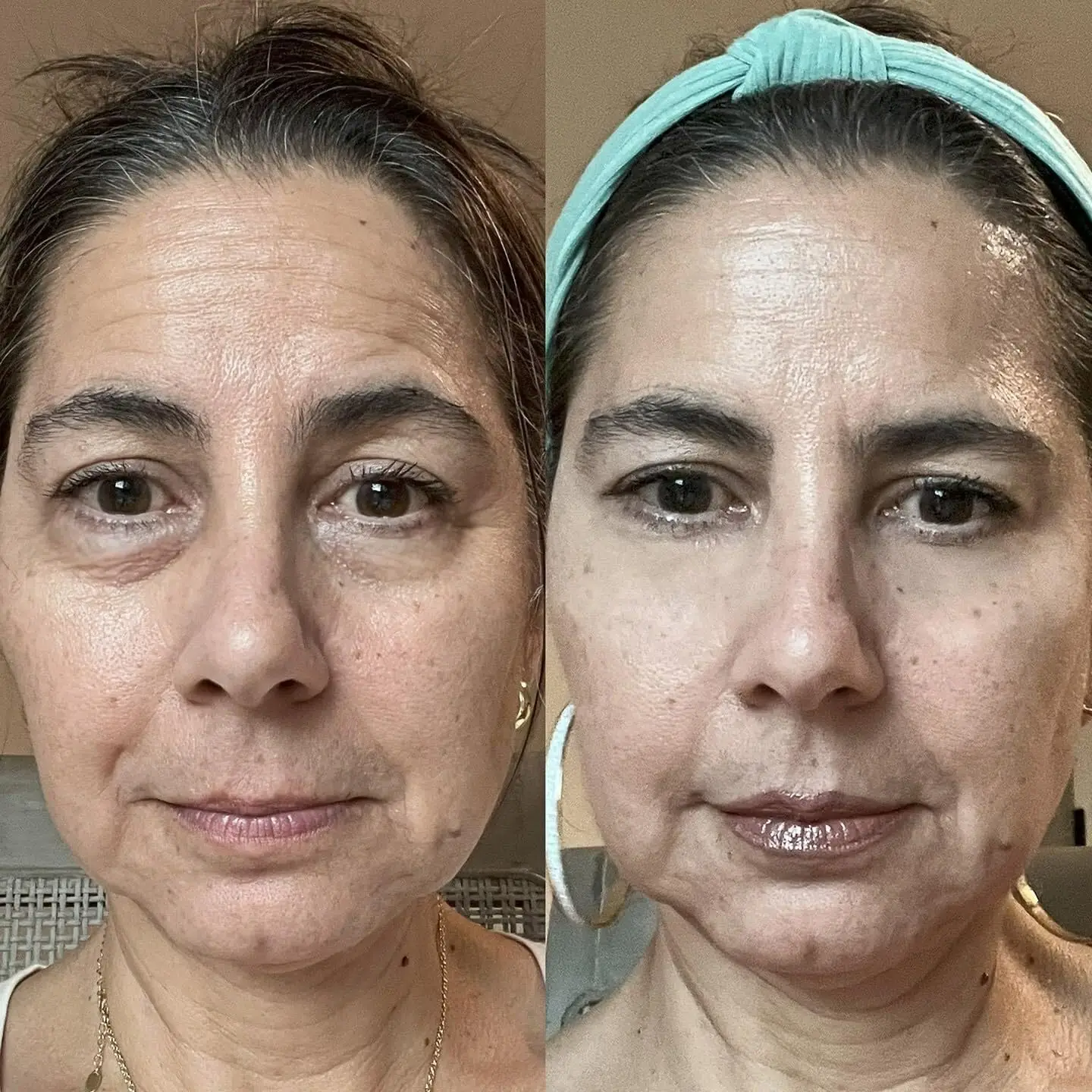 RevitalEyes by BOTANIQUE PARIS – Lunettes de luminothérapie rouge – Appareil sous les yeux pour les cernes