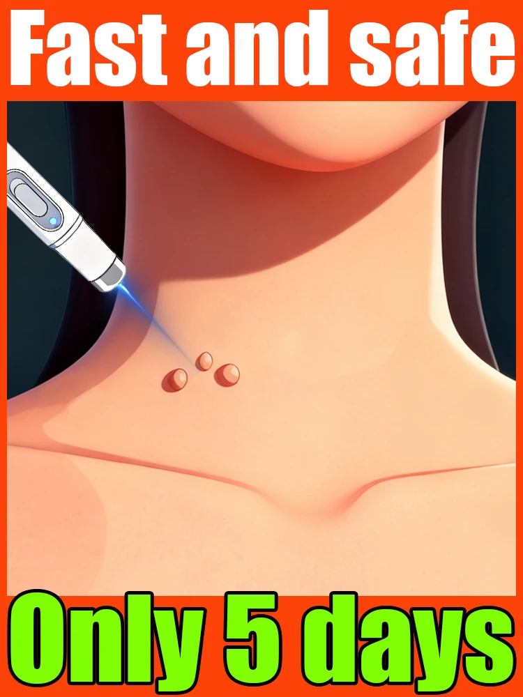 Warts Blue Light Tool  Quick wart removal