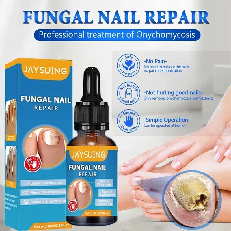 Unha Fungal Tratamento Serum, Reparação Essência, Unha Fungus Remoção Gel, Anti Infecção, Paroníquia, Onicomicose, Cuidados com os pés, 1 Pc, 2 Pcs, 4 Pcs, 5Pcs