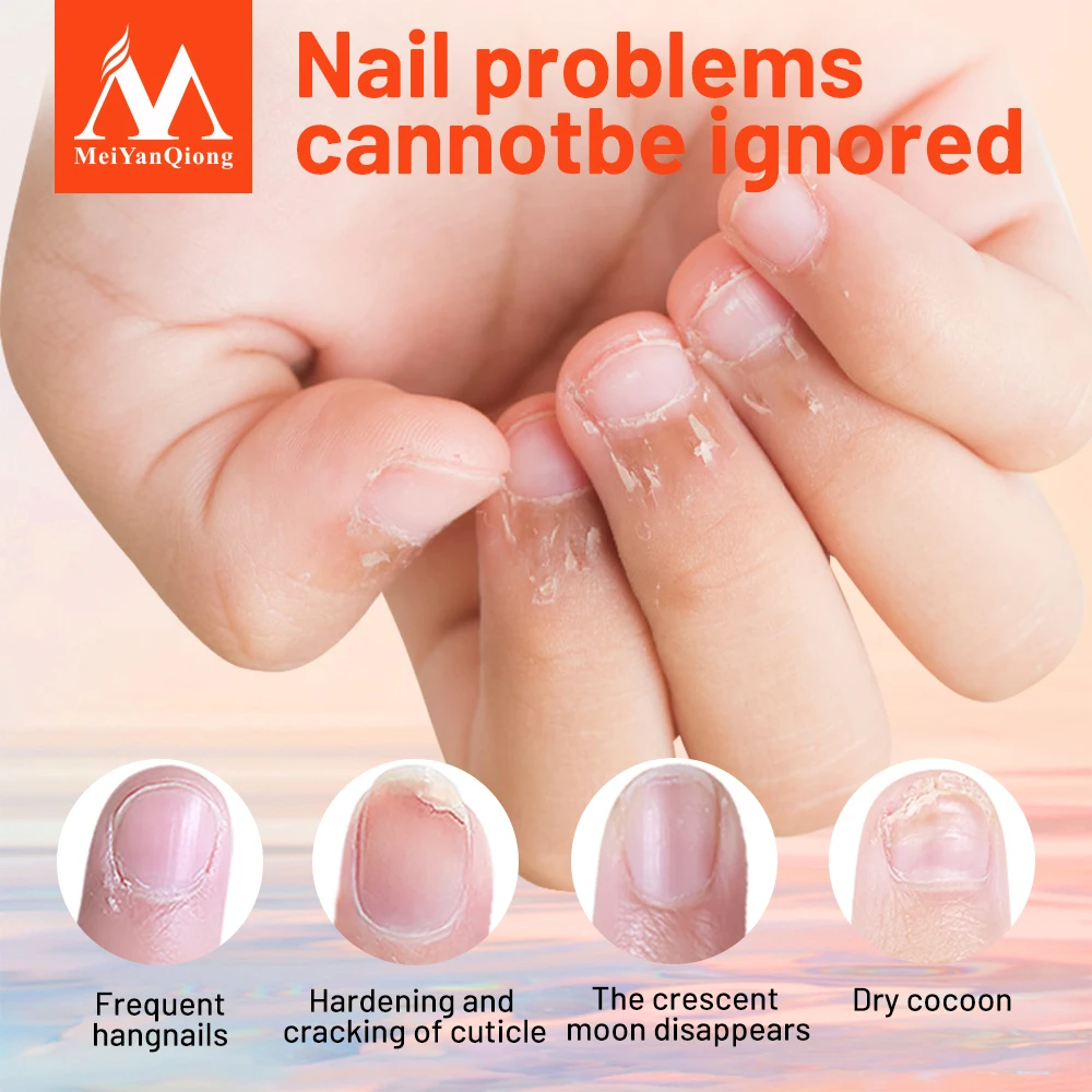 Nail Treatment Feet Care Essence Nail Foot Whitening Toe Nail Fungus Removal Gel Anti Infection Paronychia Onychomycosis